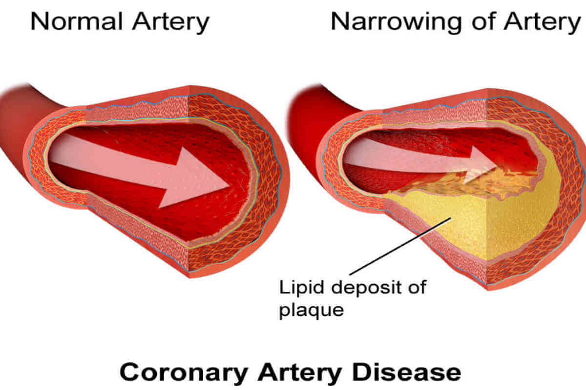 List of blood tests for weight loss #3: Lipid profile tests